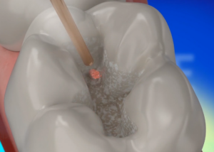 Hamba puurimine laseriga