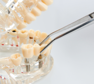 SIldprotees implantaatidel