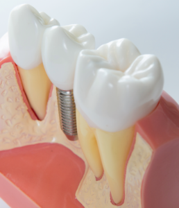 Dental Implant