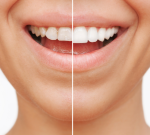 Laminaadid Veneers